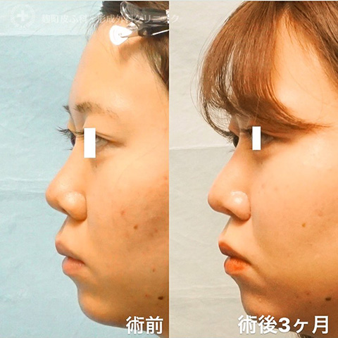 症例写真「忘れ鼻形成（鼻尖形成）」「耳介軟骨移植」［術後3か月］CASE 02