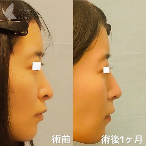 症例写真「忘れ鼻形成」（鼻尖形成3D法）（鼻中隔延長）（プロテーゼ入れ替え）