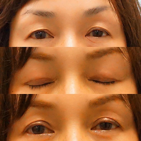 症例写真「眼瞼下垂症」（40代女性）