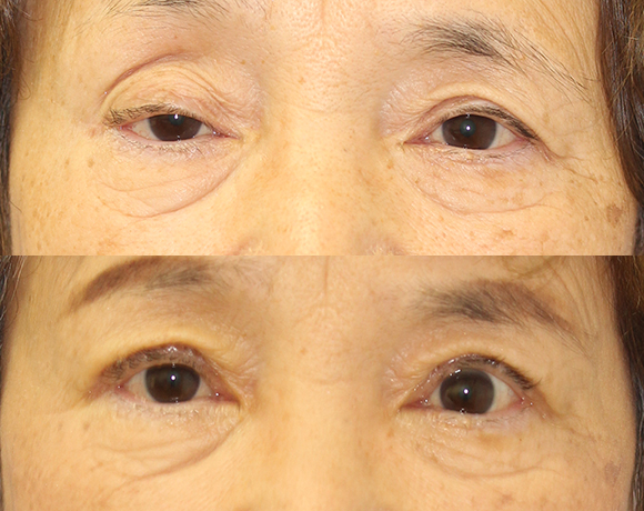症例写真「眼瞼下垂」目元の整形（70代女性）[術前/術後]