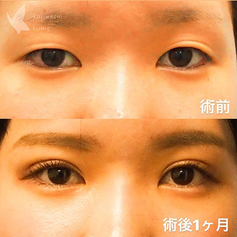 症例写真【オリジナル埋没法】［術前/1ヶ月］左右差・眼瞼下垂