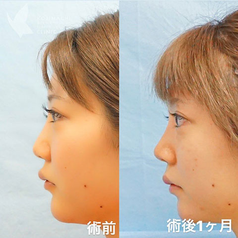 症例写真「忘れ鼻形成」「鼻尖形成」「耳介軟骨移植」（20代女性）［術後1か月］CASE 05