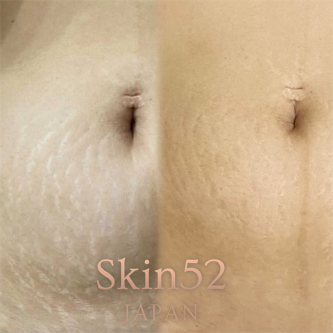 症例写真「Skin52」（女性）[術前/術直後] CASE 05