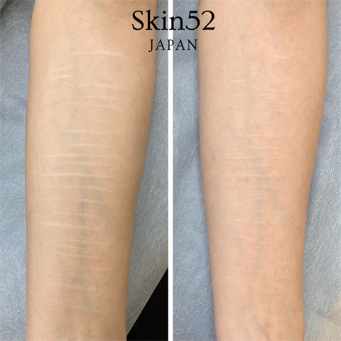 症例写真「Skin52」（女性）[術前/術直後] CASE 08
