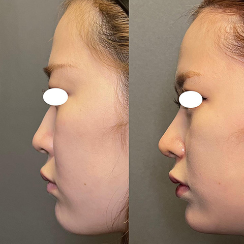 症例写真「忘れ鼻形成」「鼻尖形成」「耳介軟骨移植」「鼻中隔延長」