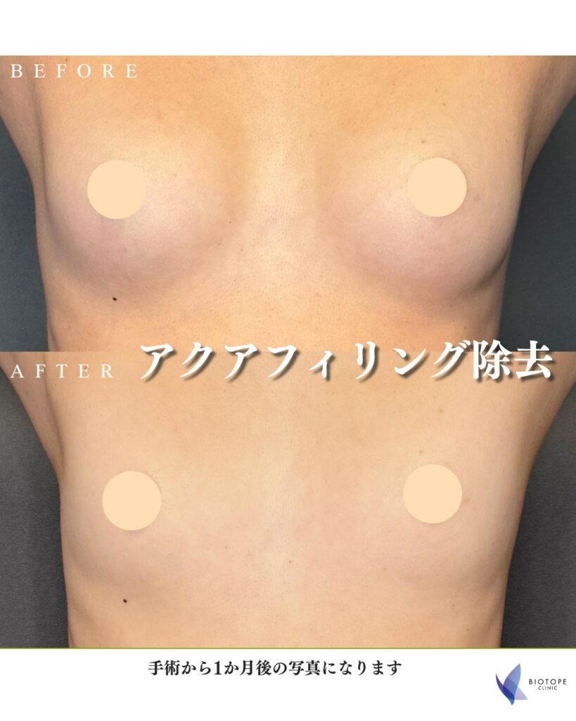 アクアフィリング除去｜術後1か月の症例